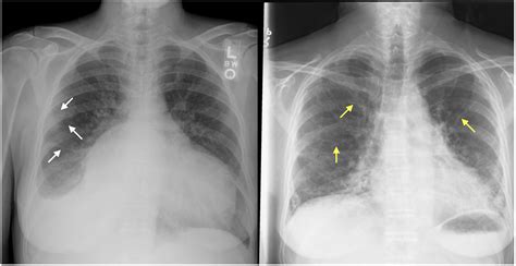 suspicious densities in both upper lobes|Lung Opacity: Understanding What This Means .